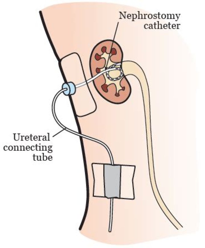 Are Nephrostomy tubes permanent
