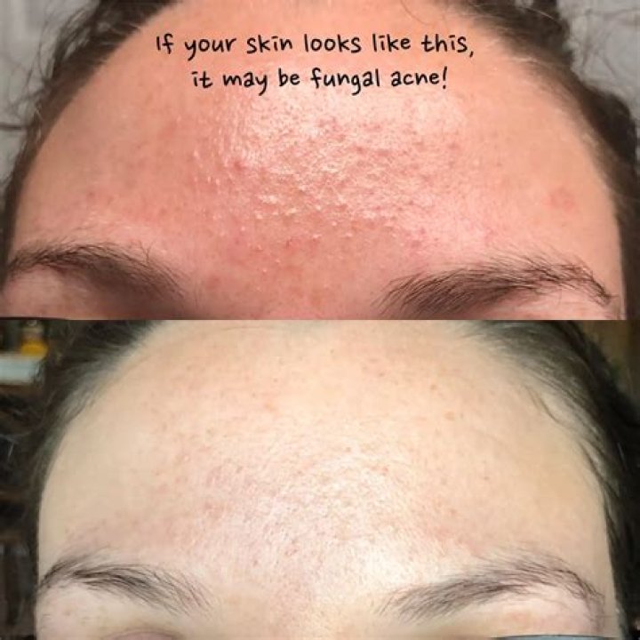 Can dandruff affect your face?
