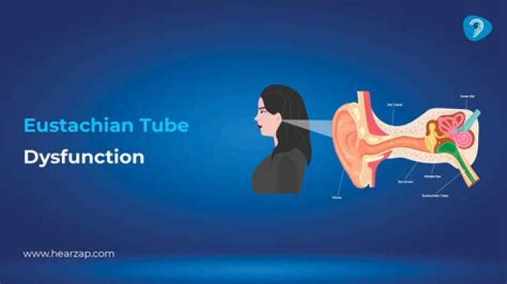 Can Eustachian tube dysfunction cause balance issues?