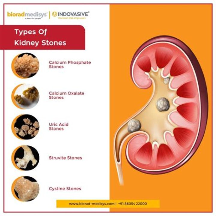Can kidney stones be related to cancer?