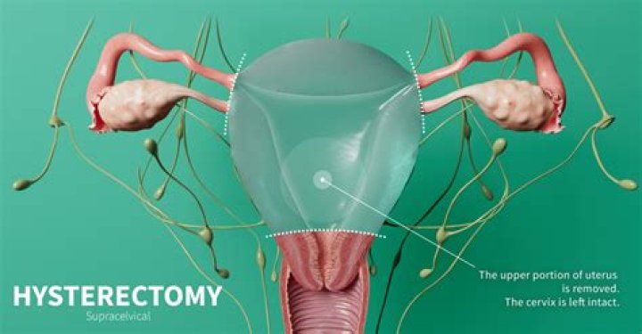Can ovaries cause problems after hysterectomy?