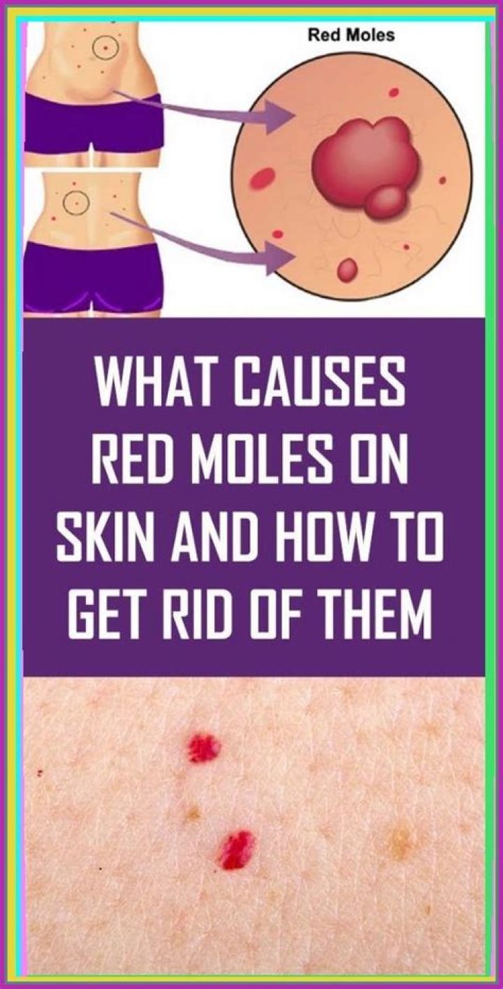 Can pregnancy cause red moles?