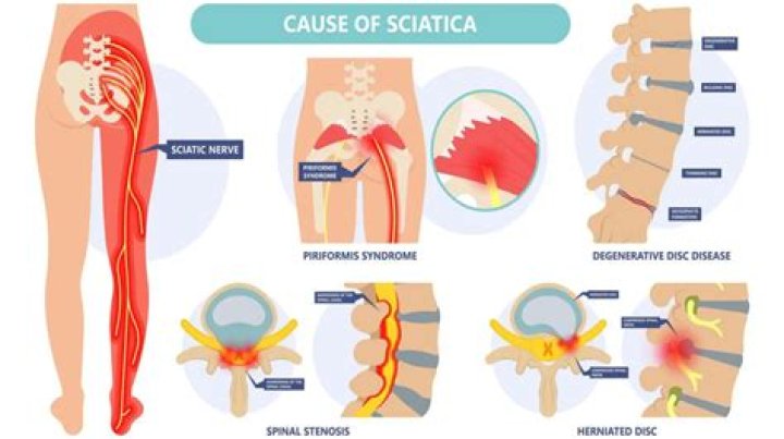 Can sciatica cause muscle atrophy