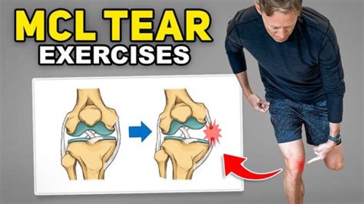 Can you walk on a Grade 3 MCL tear?