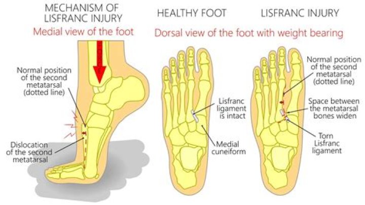 Does a Lisfranc ligament tear need surgery?