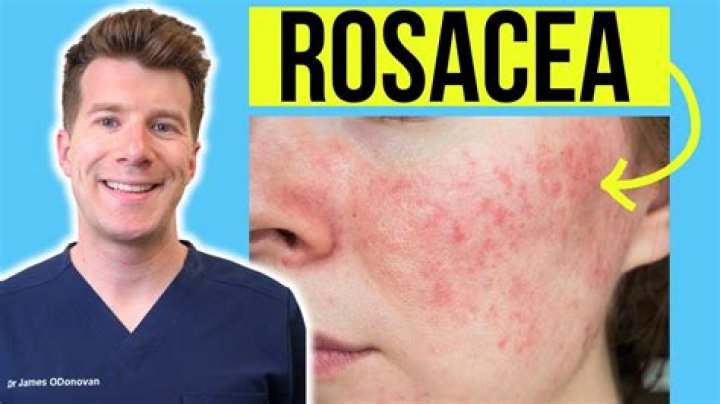 Does cleansing help with rosacea?
