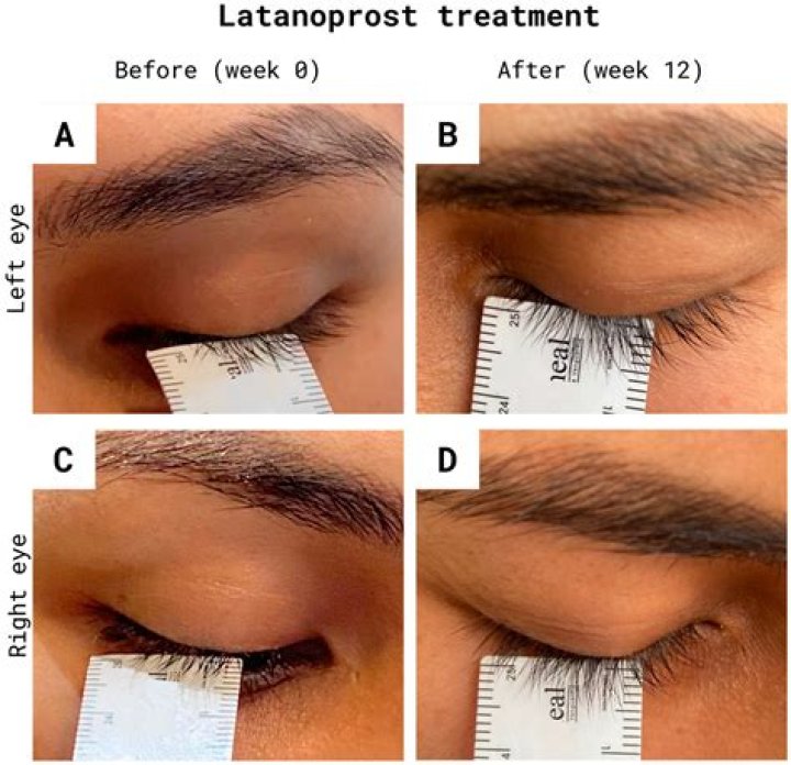 Does latanoprost cause hair growth?