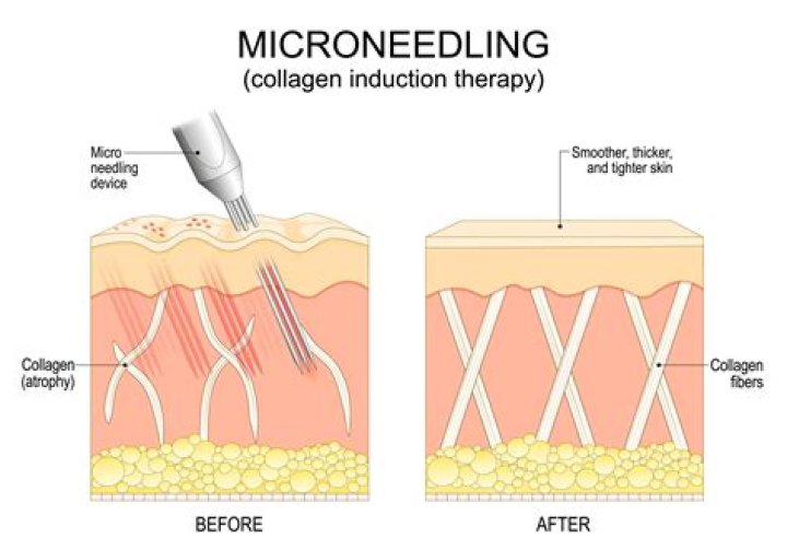 Does microneedling help with skin cancer?