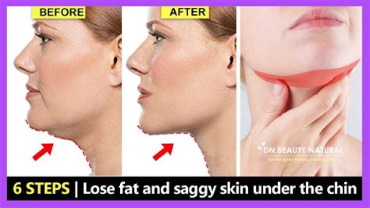 How do I get rid of the fat under my chin?