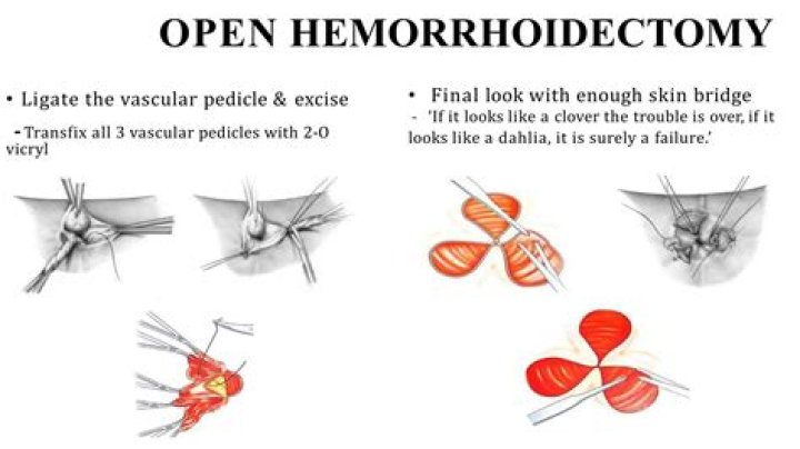 How do I know if my hemorrhoidectomy is infected