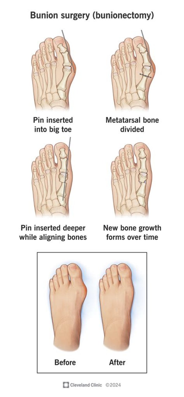 How do I strengthen my toes after bunion surgery?
