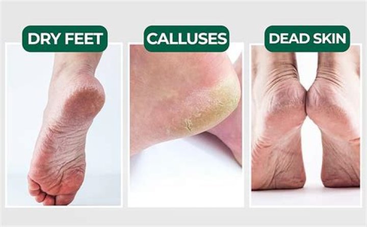How do you get rid of rough skin on bottom of feet?