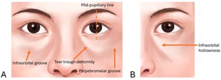 How do you stop periorbital edema