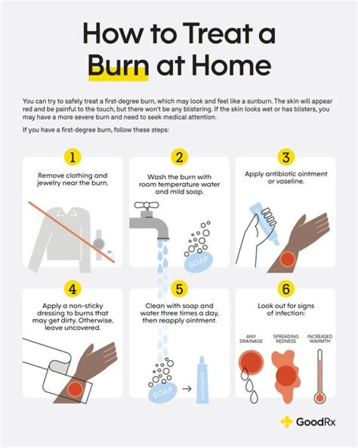 How do you treat a burn from boiling water?