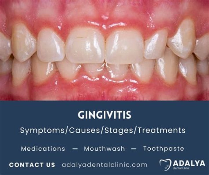 How do you treat menopausal Gingivostomatitis?