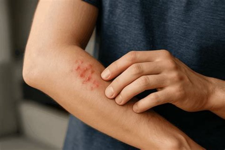 How do you treat rat mite bites on humans?