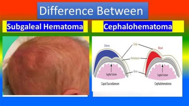 How do you treat subgaleal hematoma?
