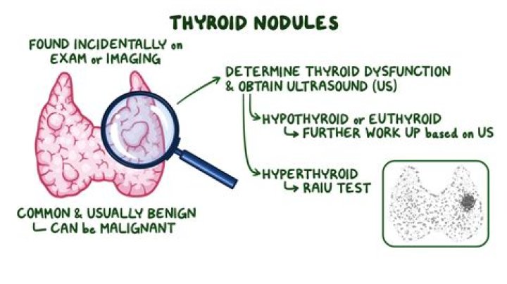 How do you treat thyroid nodules?