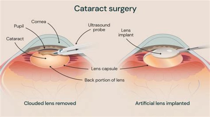 How long after cataract surgery can you tan?