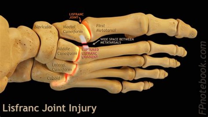 How long does it take to recover from a Lisfranc fracture