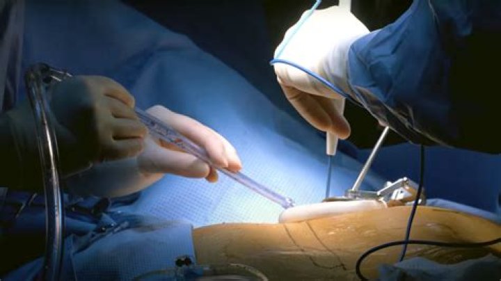How long does it take to recover from a VATS lobectomy?
