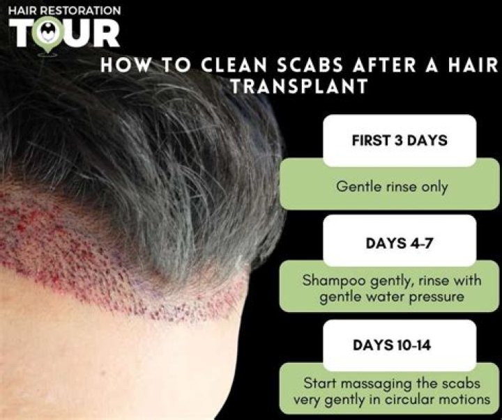 How many days after hair transplant scabs fall off?