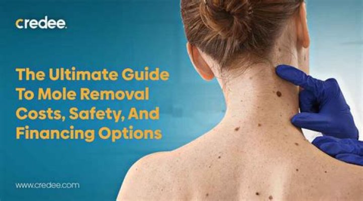 How much does it cost to get a mole removed from your nose?