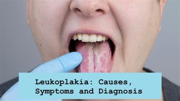 How serious is leukoplakia?