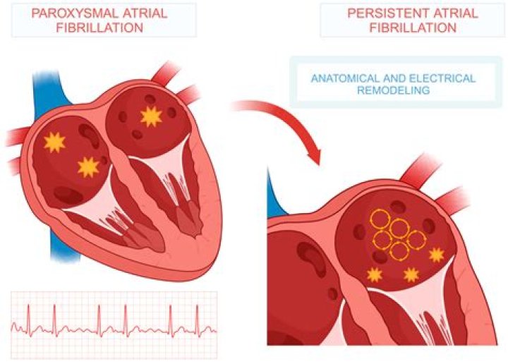 How serious is paroxysmal atrial fibrillation?