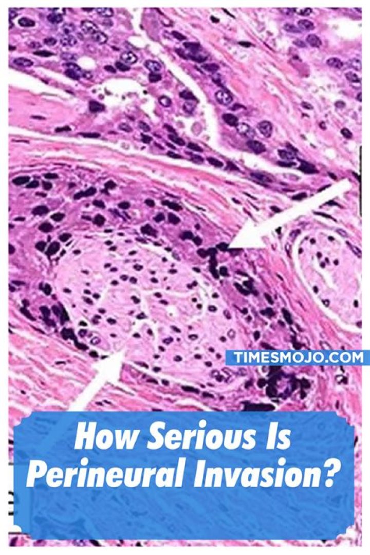 How serious is perineural invasion?