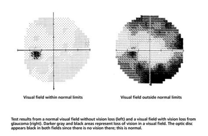 How visual field test is done