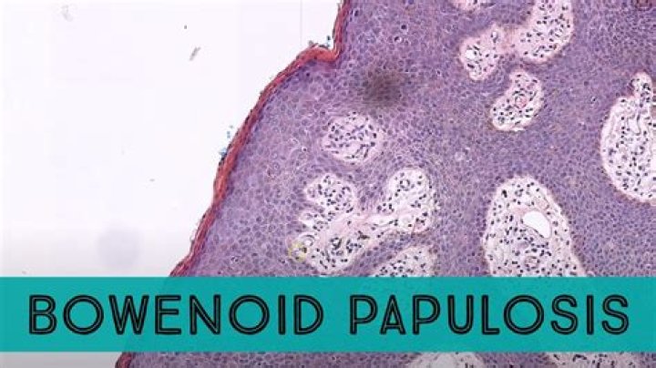 Is bowenoid papulosis serious?