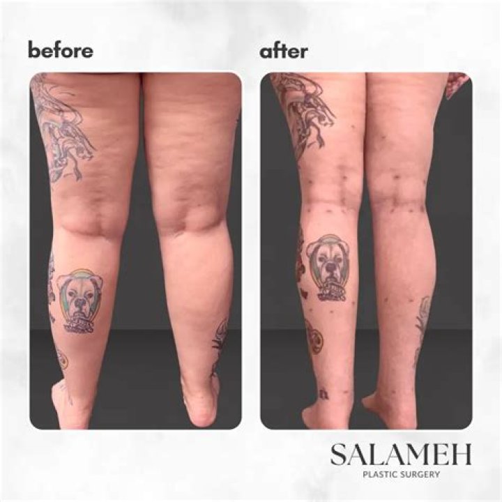 Is calf liposuction permanent?