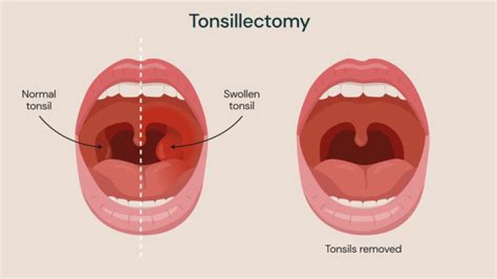 Is it normal to get a cold after a tonsillectomy