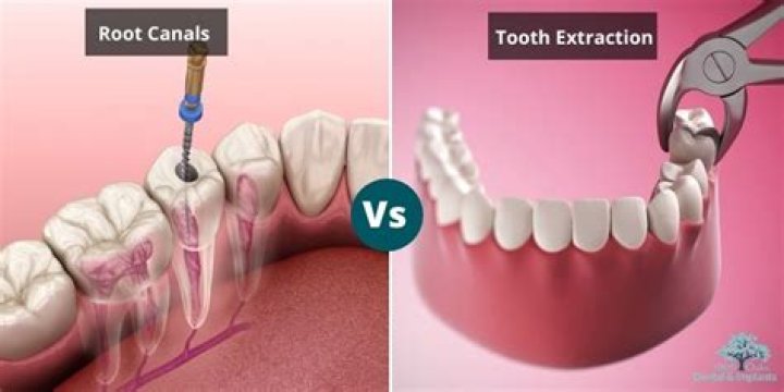 Is it painful to extract a root canal tooth?