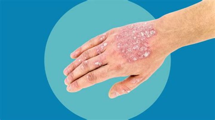 Is psoriasis a extensor surface?