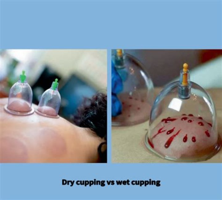Is Wet cupping legit?
