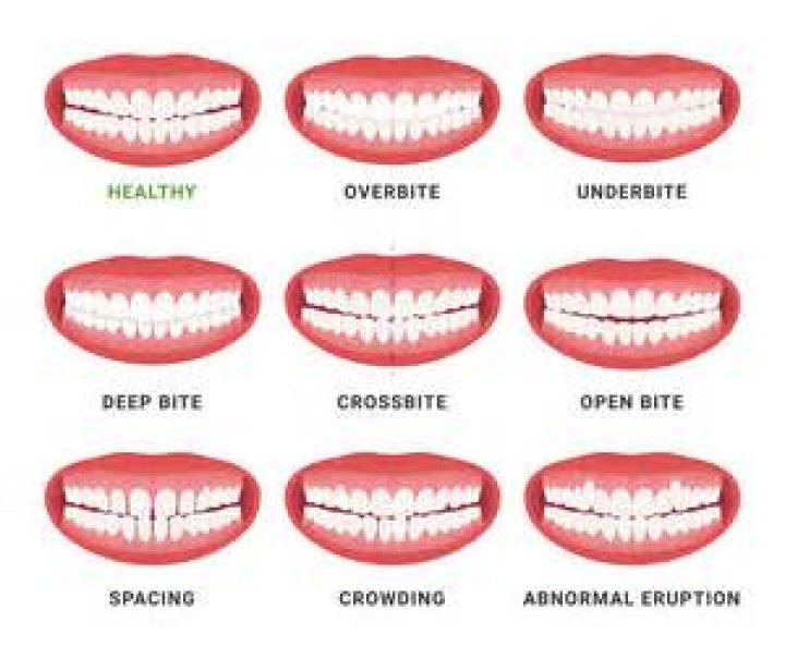 What are high teeth? | ContextResponse.com