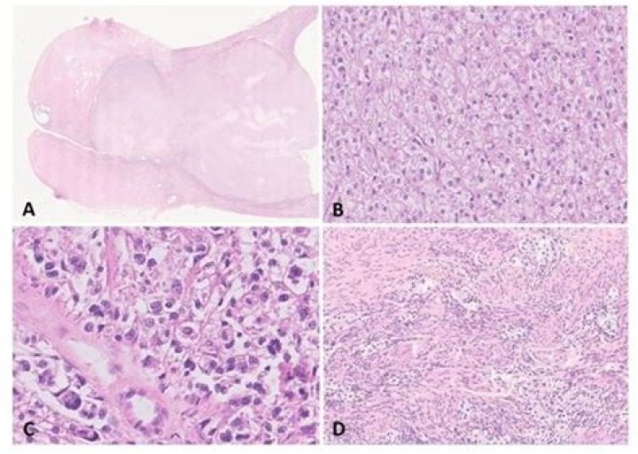 What are perivascular epithelioid cell?