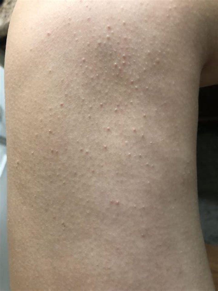 What are the little bumps on leaves?