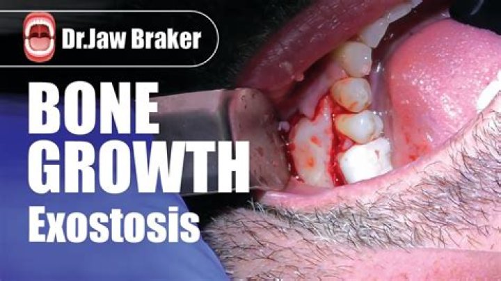 What causes extra bone growth in the mouth
