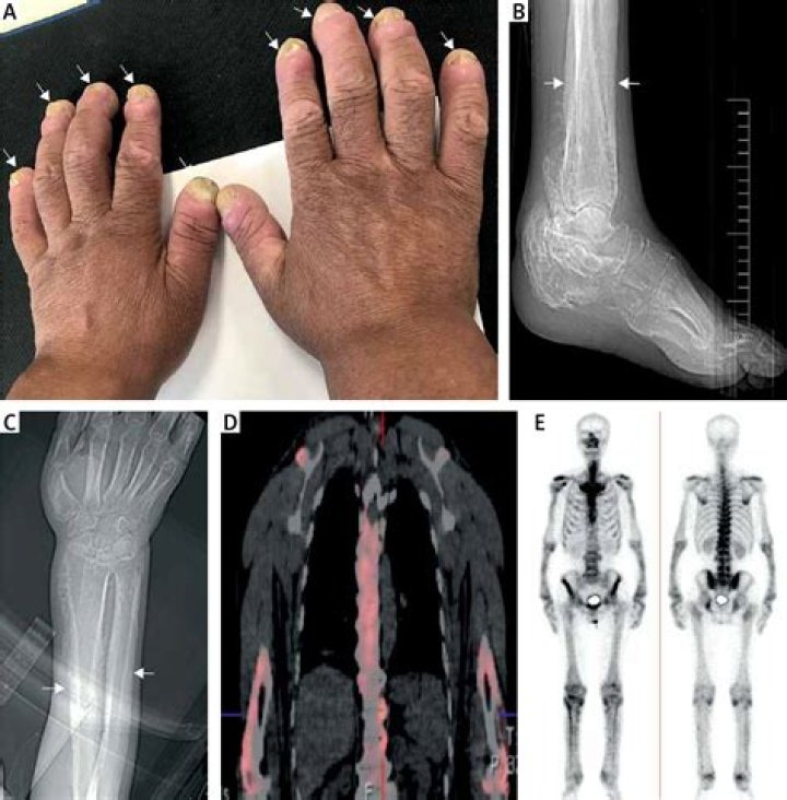 What causes hypertrophic osteoarthropathy