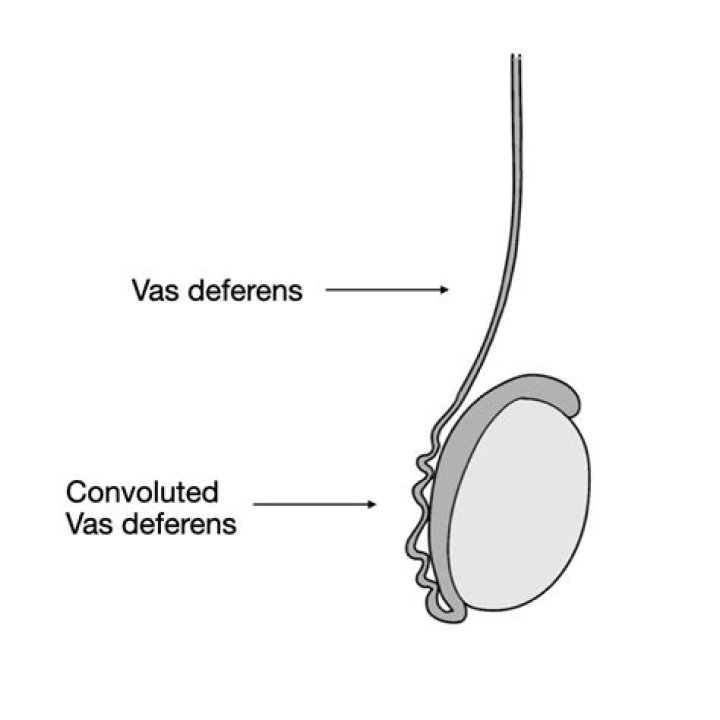 What causes swollen vas deferens