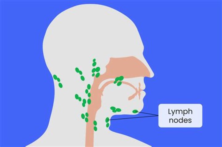 What do shotty lymph nodes mean?