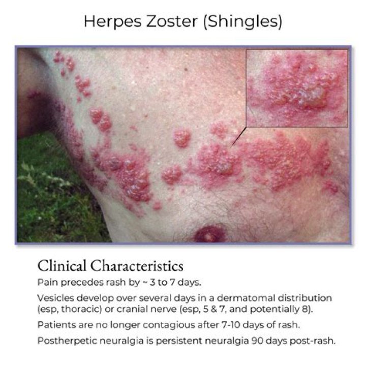 What does a Herpe lesion look like?