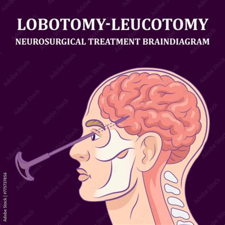 What does lobotomy mean in psychology