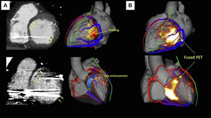 What does the delayed enhancement indicate on the cardiac MRI?