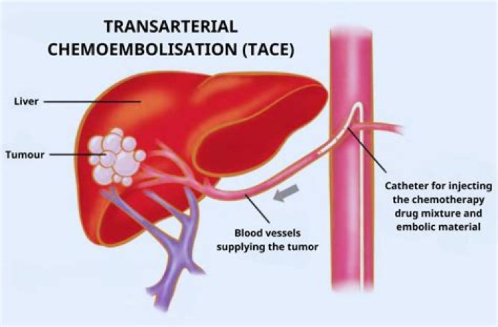 What drugs are used in chemoembolization?
