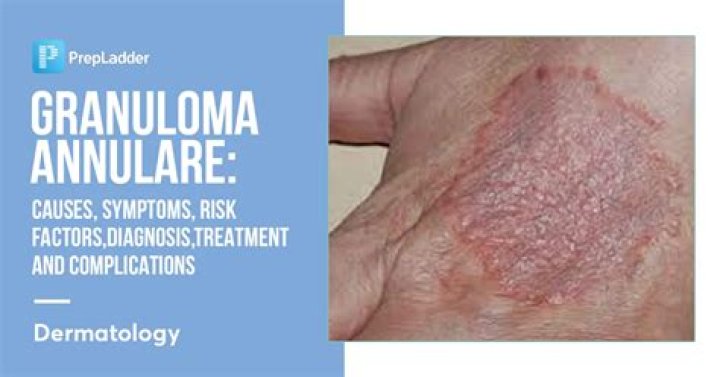 What drugs cause granuloma annulare?
