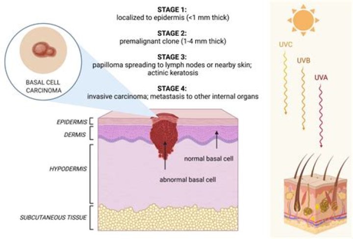What is a basal like tumor?